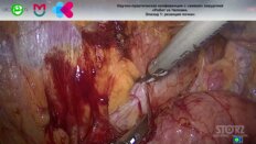 Биктимиров Т.Р. - Лапароскопическая резекция почки с применением ICG