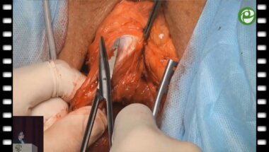 Гуспанов Р.И. - Аугментационная анастомотическая пластика уретры с использованием слизистой щеки