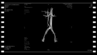 Капто А.А. МРТ, ангиопластика и стентирование у мужчины при May-Thurner syndrome.