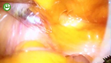 Галлямов Э.А. - Лапароскопическая парциальная нефрэктомия