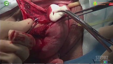 Каппушева Л.М. - Хирургическая коррекция тазового пролапса: задний компартмент из вагинального доступа