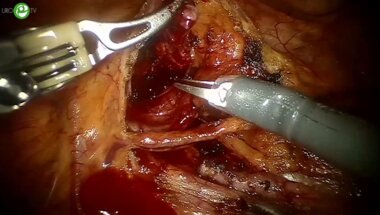 Безруков Е.А. - Робот-ассистированная пластика ЛМС