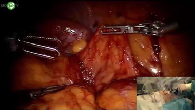 Ракул С.А. - Робот-ассистированная резекция почки с опухолевым узлом