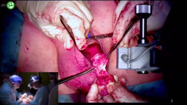 Гулько А.М - Глансэктомия с реконструкцией головки полового члена уретральным лоскутом