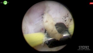 Сорокин Н.И. - Биполярная энуклеация простаты