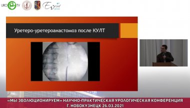 Холтобин Д.П. - Особенности лапароскопической пластики мочеточников