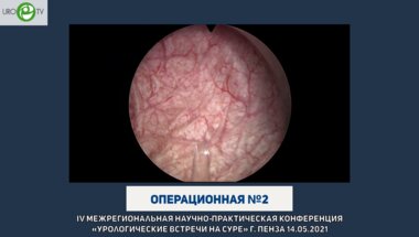 Дымов А.М. - Энуклеация простаты тулиевым лазером