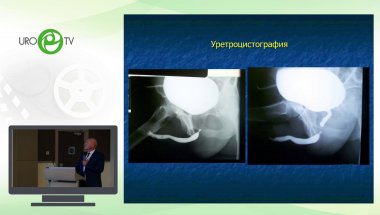 Даренков С.П. - Дистракционный дефект уретры при переломах костей таза