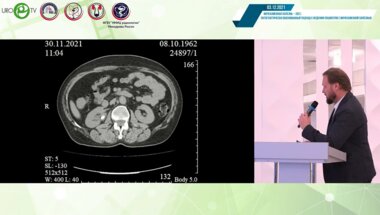 Меринов Д.С. - Фиброуретеропиелолитотрипсия