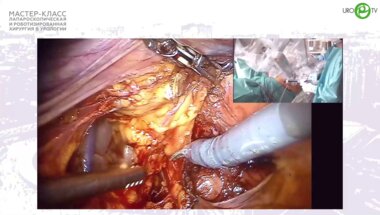 Павлов В.Н. - Робот-ассистированная экзентерация таза. Радикальная цистэктомия