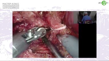 Пушкарь Д.Ю. - Робот-ассистированная радикальная простатэктомия с нервосбережением