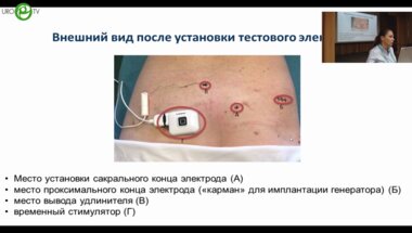 Коршунова Е.С. - Сакральная нейромодуляция. Опыт нейроуролога