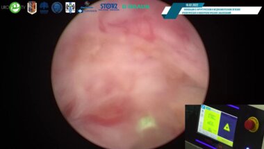 Цариченко Д.Г. - Трансуретральная лазерная энуклеация аденомы простаты