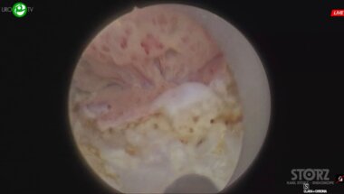 Дымов А.М. - Низкомощная энуклеация гиперплазии простаты, лазерная резекция мочевого пузыря EN BLOC