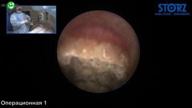 Мазуренко Д.А. - Миниперкутанная нефролитотрипсия