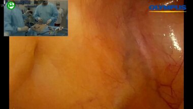 Холтобин Д.П. - Лапароскопическая простатэктомия с расширенной тазовой лимфодиссекцией