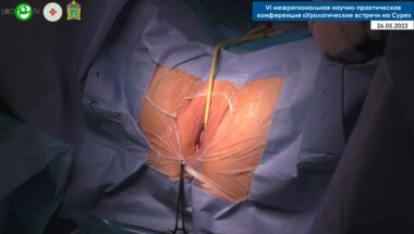 Миронов М.А. - Установка нового субуретрального женского слинга I-STOP