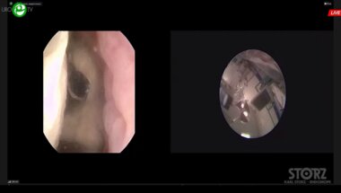 Гаджиев Н.К., Малхасян В.А. - Комбинированная интраренальная хирургия с использованием технологии миниперк