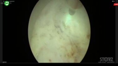 Сорокин Н.И. - Энуклеация гиперплазии простаты