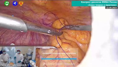 Холтобин Д.П. - Лапароскопическая простатэктомия с ICG
