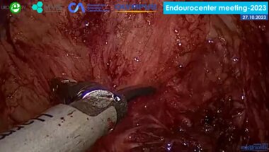 Аль-Аттар Т.Х. - Лапароскопическая аденомэктомия