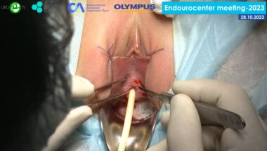 Комяков Б.К. - Транспозиция уретры по Комякову Б.К.