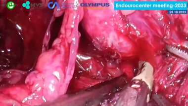 Сергеев В.П. - Лапароскопическая простатэктомия (унилатеральный доступ)