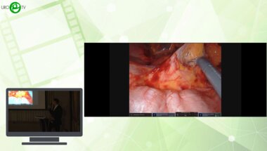 Зырянов А.В. - Роботассистированная Davinci Xi резекция интраренальной опухоли левой почки