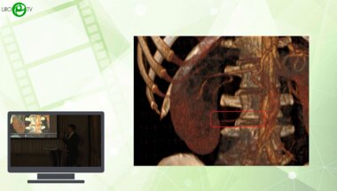 Зырянов А.В., Сальников И.М., Агзамов А.В. - Роботассистированная Davinci Xi антевазальная пластика ЛМС у ребенка