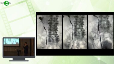 Фокин И.В. Азильгареева К.Р., Еникеев М.Э., Рапопорт Л.М. - Лапароскопическая тотальная трансмезентериальная уретероилеопластика справа с отдаленными результатами