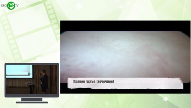 Франк М.А., Михельсон А.А., Мурзин М.О., Замятин А.В., Санжаров А.Е., Шамуратов Р.Ш. - Лапароскопическая фистулопластика генитальных свищей