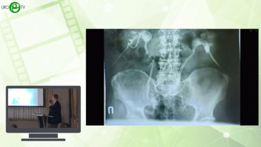 Перлин Д.В. - Лапароскопическая пластика при стриктуре анастомоза после операции Брикера