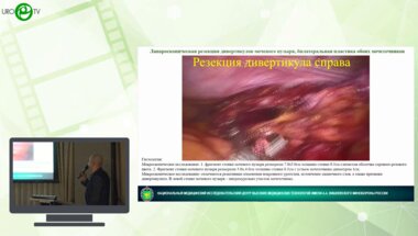 Кочетов А.Г., Салюков Р.В., Плеханова О.А., Пчелинцев А.С. - Дивертикулы Хатча и гигантский дивертикул мочевого пузыря