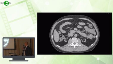 Шкодкин С.В. - Эндовезикальное дренирование. Лазерная инцизия стриктуры