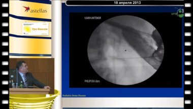 Тегюл С. - Малоинвазивные методы лечения мочекаменной болезни у детей (Университет Hacettepe, Анкара, Турция)