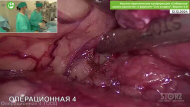 Симонов П.А. - Лапароскопическая резекция почки, нефрэктомия