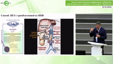 Галлямов Э.А. - Лапароскопическая тромбэктомия из НПВ