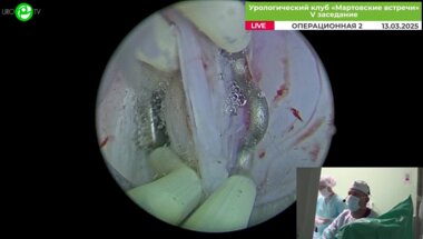 Лавинский Р.В. - Электроэнуклеация ДГПЖ с использованием генератора BOWA и морцеллятора SoftCut