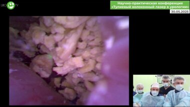 Малхасян В.А. - Гибкая ретроградная интраренальная хирургия