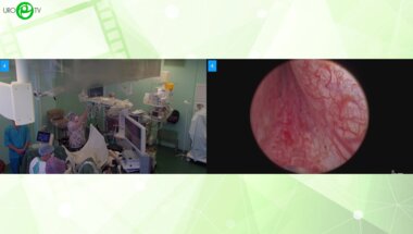 Сорокин Н.И. - Тулиевая лазерная энуклеация гиперплазии простаты KUNZ