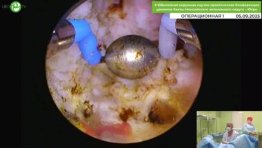 Дымов А.М. - Трансуретральная лазерная энуклеация гиперплазии простаты с применением туливого волоконного лазера