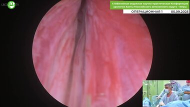 Дымов А.М. - Трансуретральная лазерная энуклеация гиперплазии простаты с применением гольмиевого лазера