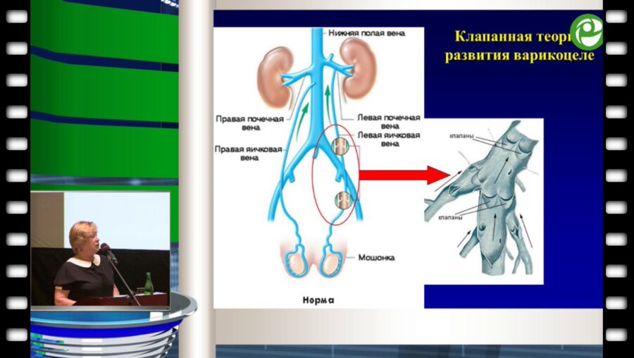 Меновщикова Л.Б. - Обоснование диагностического и лечебного протокола при варикоцеле у детей и подростков