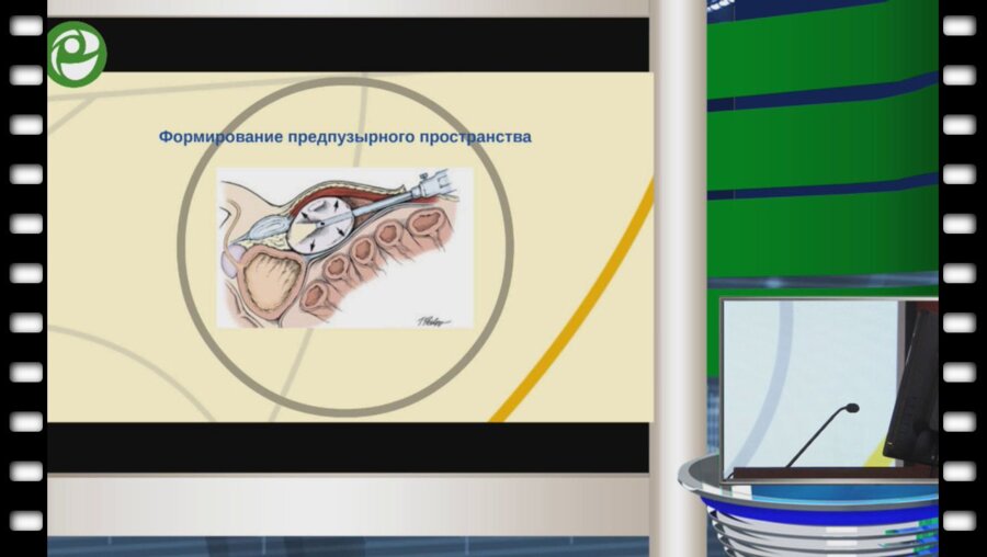 Попов С.В. - Лапароскопическая простатэктомия 2015