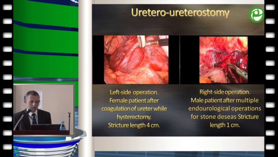 Лапароскопическая коррекция ятрогенных стриктур мочеточника