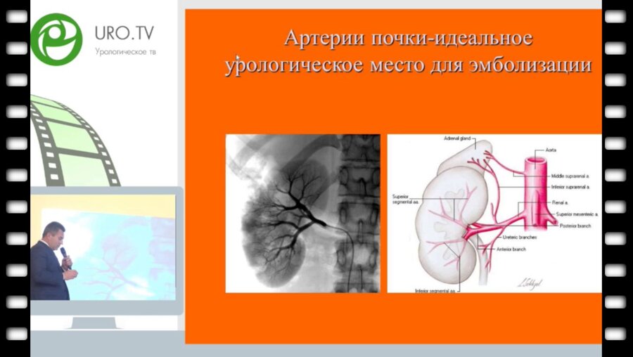 Жуков О.Б. - Рентгенэндоваскулярный гемостаз и химиоэмболизации у онкоурологических больных
