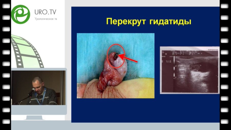 Володько Е.А. - Дискуссионные вопросы в диагностике и личении личения детей с острыми заболеваниями яичек