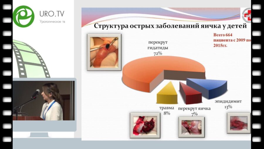 Гасанова Е.Н. - Дифференцированное лечение перекрута гидатиды у детей