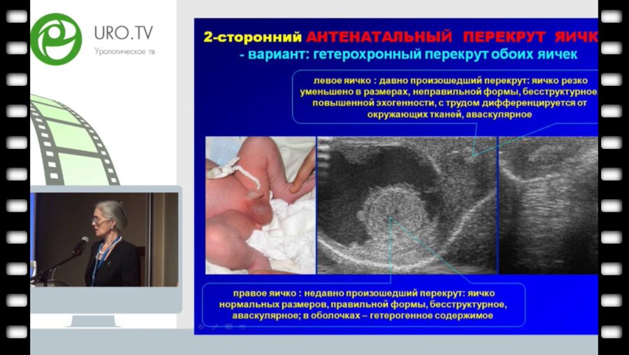Ольхова Е.Б. - Редкие варианты острой скротальной патологии