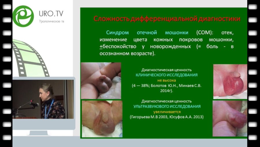 Юткина М.С. - Перекрут яйчка у детей, возможности ультразвуковой диагностики